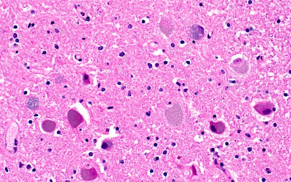 10C6 NCL (Case 10) L14 Cbell dentate nuc 40X