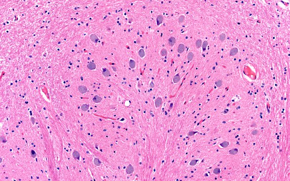10C7 NCL (Case 10) L13 ION 40X H&E