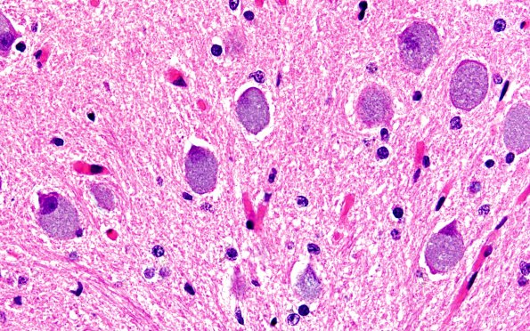 10C8 NCL (Case 10) L13 ION 60X H&E