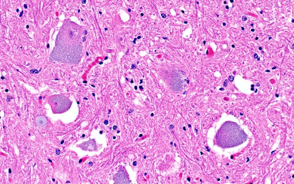 10C9 NCL (Case 10) L13 cord 40X H&E