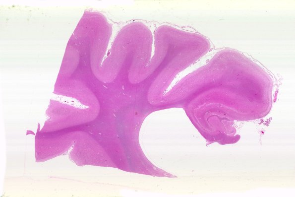 11B1 NCL (Case 11) H&E N3 WM