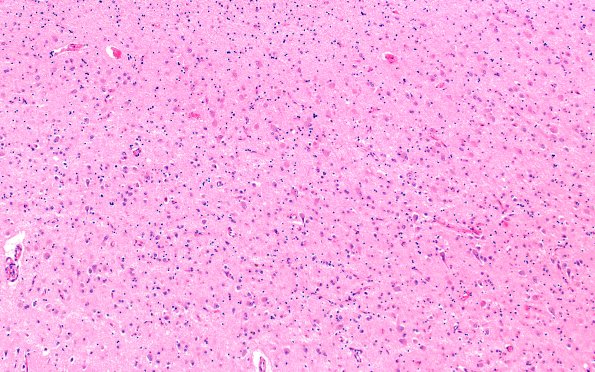 11B2 NCL (Case 11) H&E N3 temporal lobe 10X