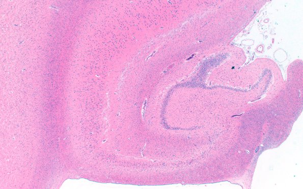 11B3  NCL (Case 11) H&E N3 CA1 2X 1