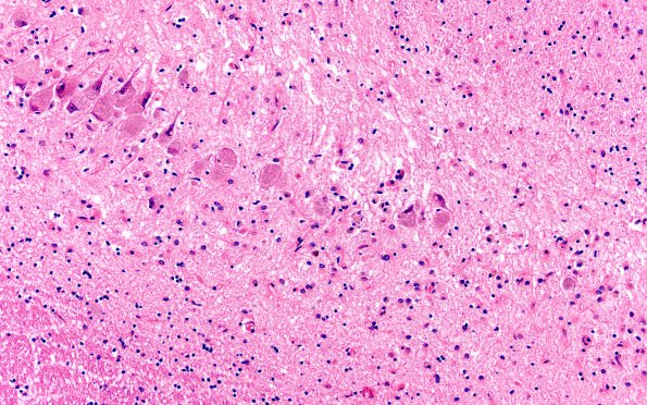 11B4 NCL (Case 11) H&E N3 CA1 20X 1