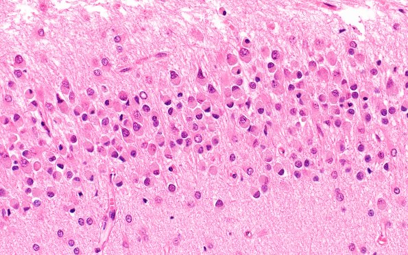 11B5 NCL (Case 11) H&E N3 dentate 40X