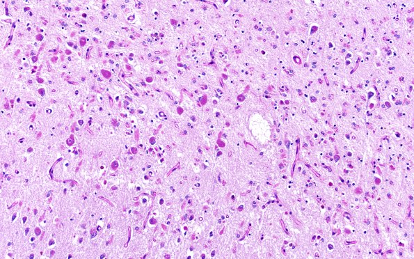 11C1 NCL (Case 11) PAS N3 temporal lobe 40X 2