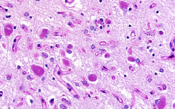 11C2 NCL (Case 11) PAS N3 temporal lobe 60X 3