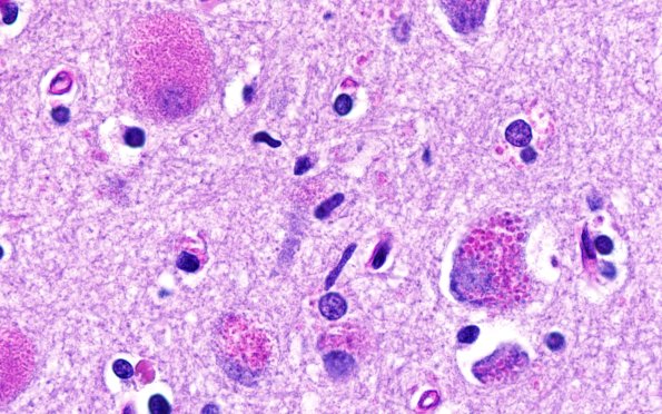 11C3 NCL (Case 11) PAS N1 100X