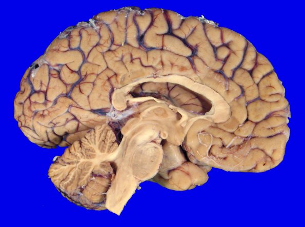 1A2 NCL (Case 1) gross 3