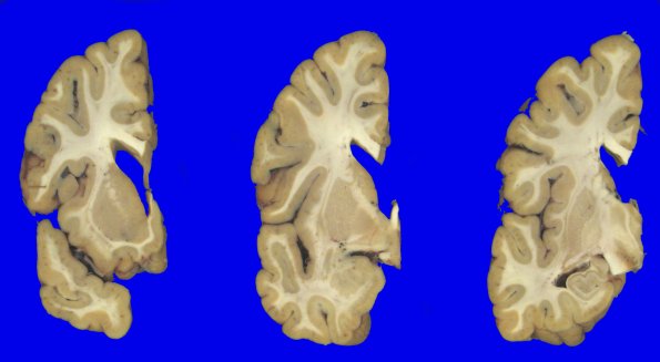 1A3 NCL (Case 1) gross 1