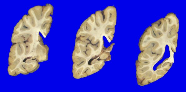 1A4 NCL (Case 1) gross 6