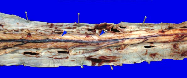 1A5 NCL (Case 1) gross 2 copy