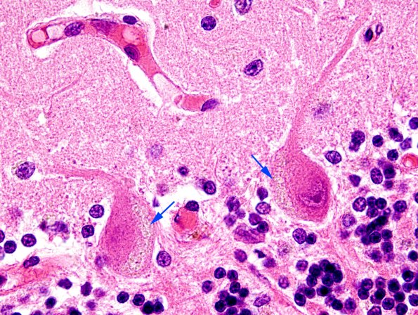 1B10 NCL (Case 1) H&E 2 copy