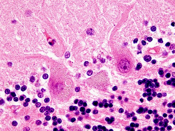 1B11 NCL (Case 1) H&E 1