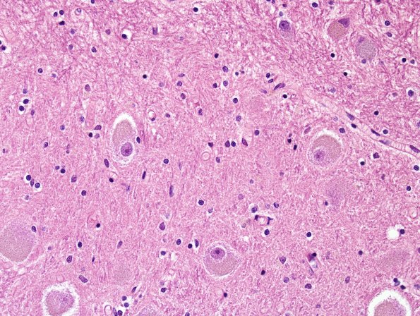 1B12 NCL (Case 1) L14 dentate H&E 2.jpg