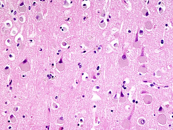 1B2 NCL (Case 1) H&E 8