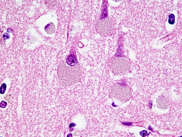 1B3 NCL (Case 1) H&E 7