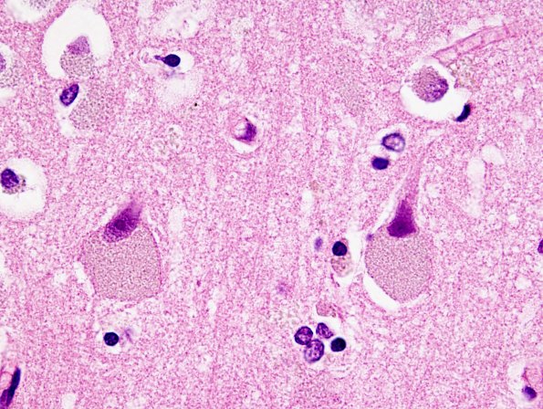 1B4 NCL (Case 1) H&E 6