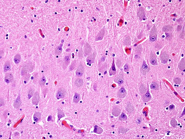 1B5 NCL (Case 1) L5 H&E 1.jpg