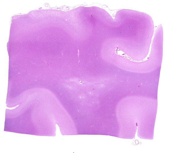 1B6 NCL (Case 1) H&E WM 2