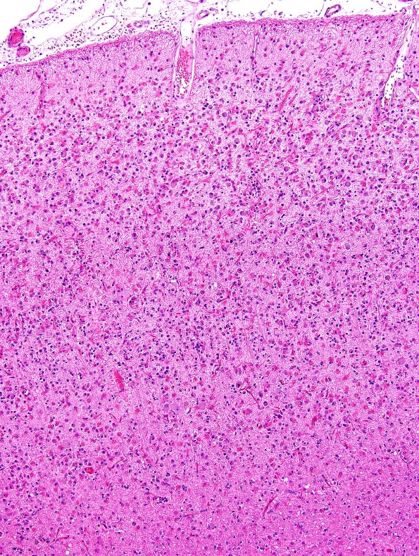 1B7 NCL (Case 1) L4 H&E 8A