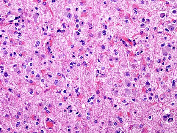 1B8 NCL (Case 1) L4 H&E 4