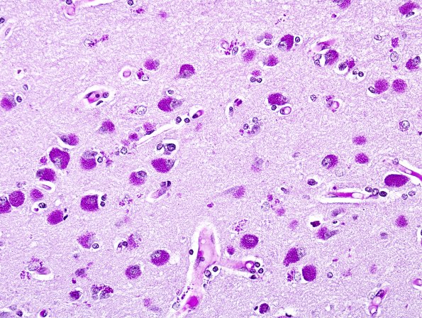 1C1 NCL (Case 1) PAS 1