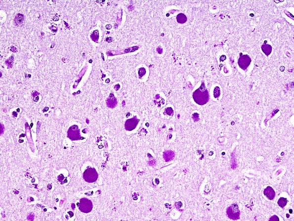 1C2 NCL (Case 1) PAS 3
