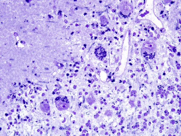 1E2 Kuf's Disease (NCL, Case 1) Plastic 4