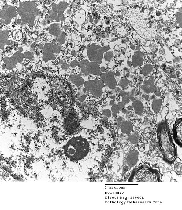 1F1B Case 1 NCL CBELL_010 - Copy