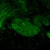 2B1 NCL, (Kuf's Dz, Case 2) Skin Autofluorescence 6