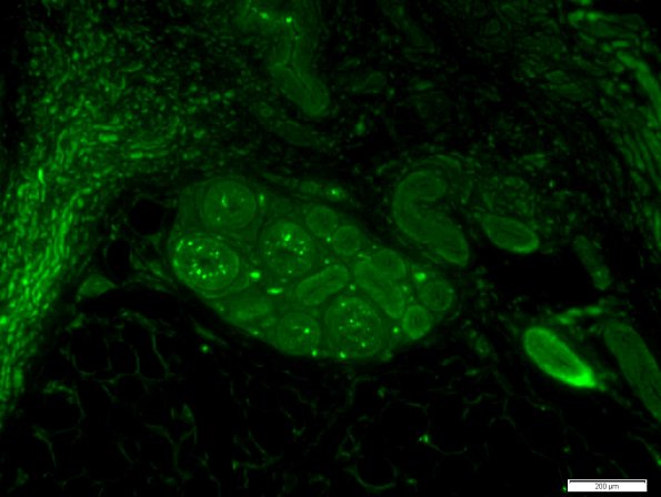 2B1 NCL, (Kuf's Dz, Case 2) Skin Autofluorescence 6