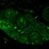2B2 NCL, Kufs Dz, (Case 2) Skin Autofluorescence 3 copy