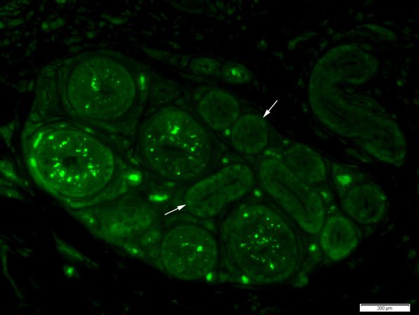 2B2 NCL, Kufs Dz, (Case 2) Skin Autofluorescence 3 copy