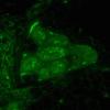2B3 NCL (Kuf's Dz, Case 2) Skin Autofluorescence 5