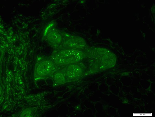 2B3 NCL (Kuf's Dz, Case 2) Skin Autofluorescence 5