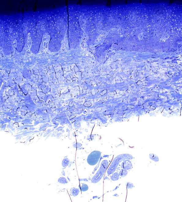 2C1 Kuf's Disease (NCL, Case 2) 4X