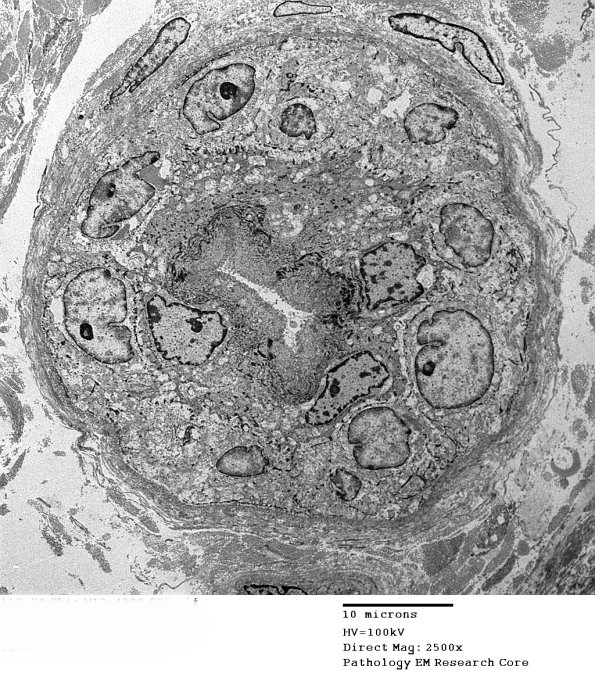 2D1A Kuf's Disease, skin (Case 2) EM 075 - Copy