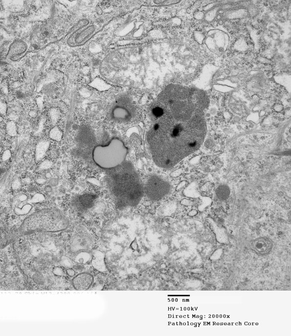 2D2B Kuf's Disease, skin (Case 2) EM 096 - Copy