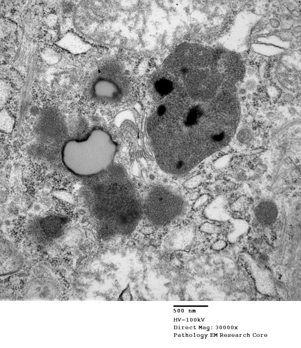 2D2C Kuf's Disease, skin (Case 2) EM 099 - Copy