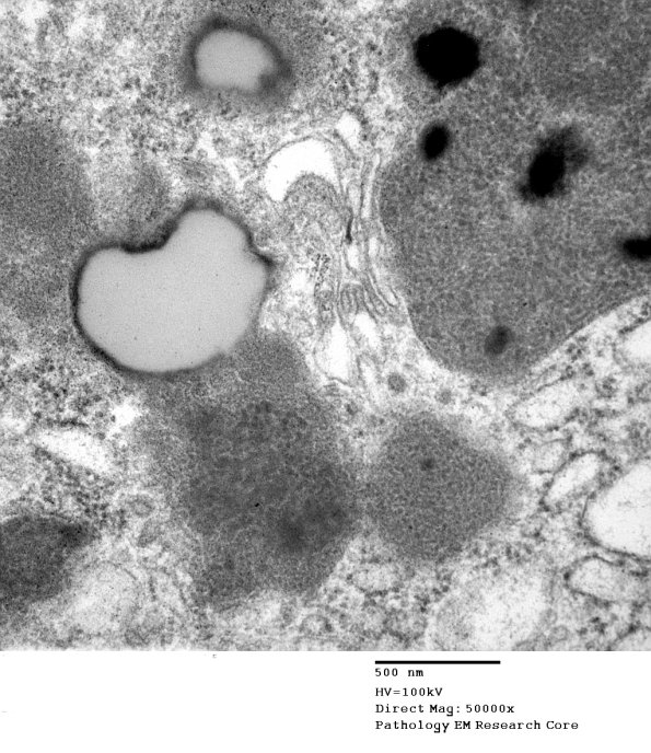 2D2D Kuf's Disease, skin (Case 2) EM 100 - Copy
