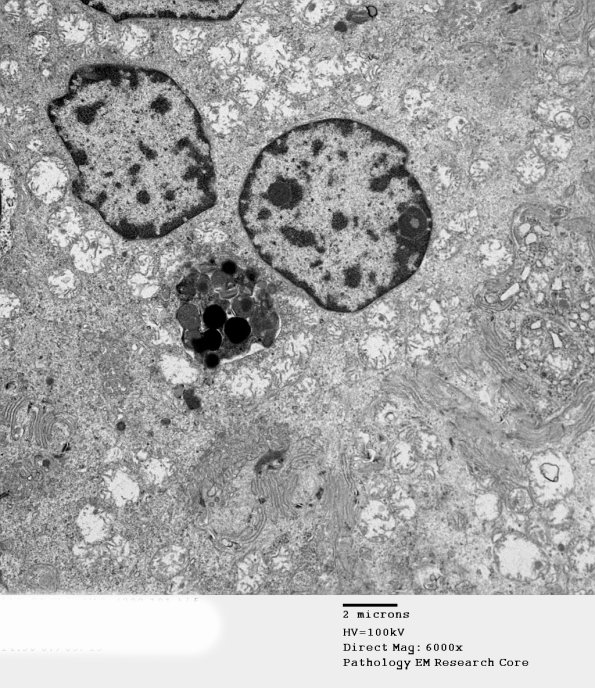 2D3A Kuf's Disease, skin (Case 2) EM 101 - Copy