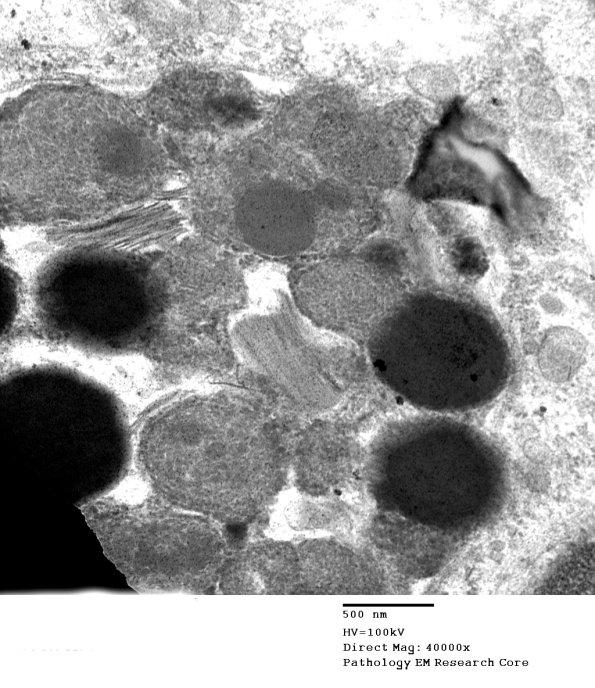 2D3B Kuf's Disease, skin (Case 2) EM 088 - Copy