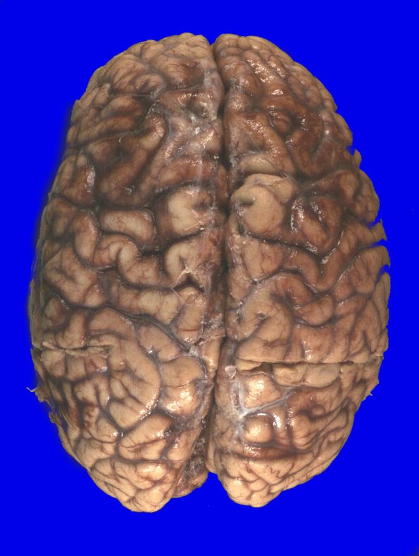 2E1 Kuf's Disease (Case 2) _2 (2)