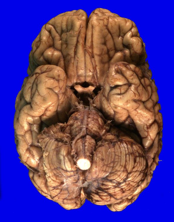 2E2 Kuf's Disease (Case 2) _1