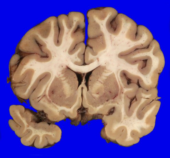 2E4 Kuf's Disease (NCL, Case 2) _5 (2)