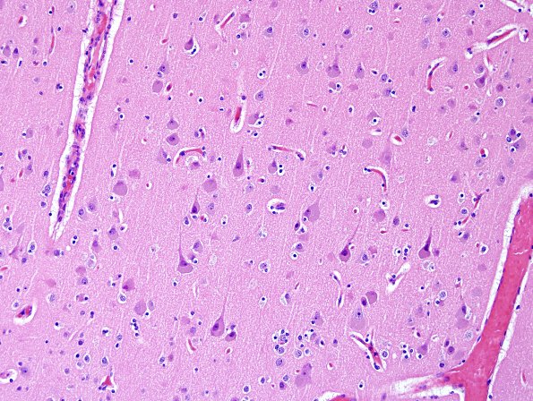 2F1 NCL (Case 2) L1 H&E 1.jpg