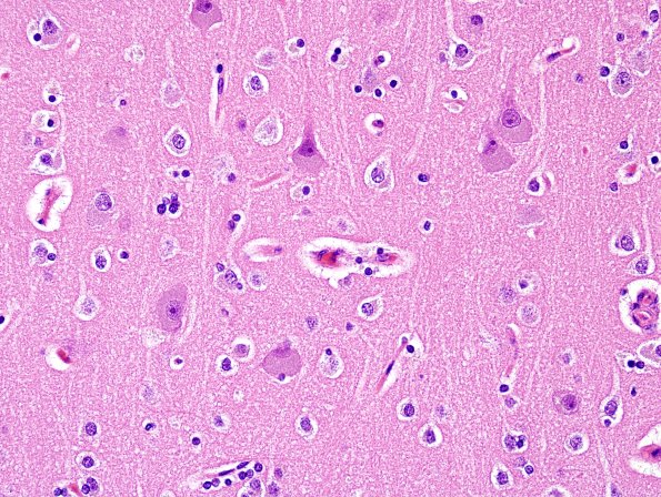 2F2 NCL (Case 2) L1 H&E 2.jpg
