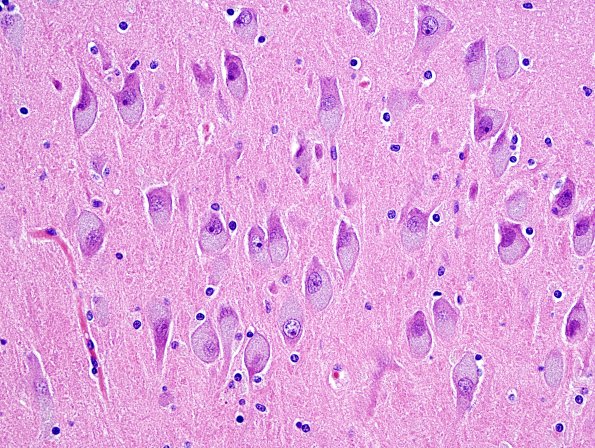 2F3 NCL (Case 2) L5 H&E 1.jpg