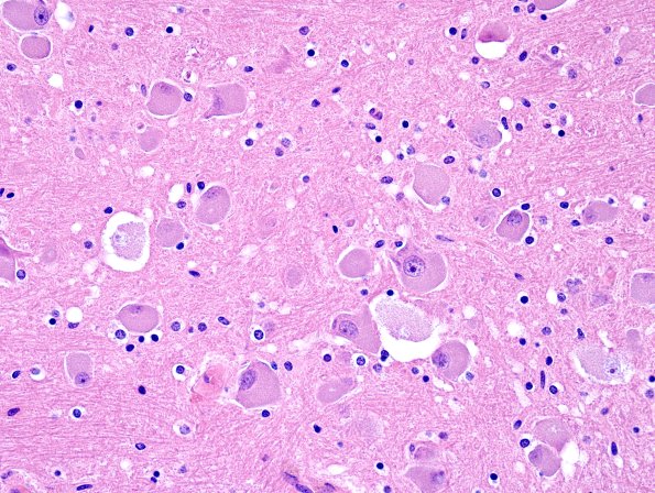 2G2 NCL (Case 2) L11 H&E 1.jpg